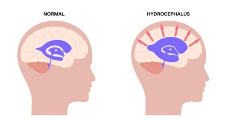 Hydrocephalus-1