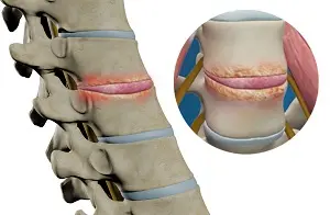 lower-back-pain-surgery