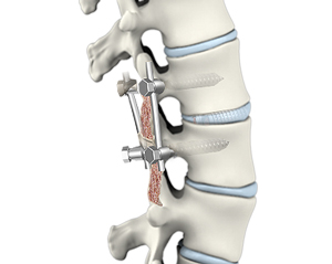 spinal-fusion